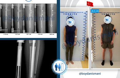 28 Yasindaki Turk Hastamizin Boy Uzatma Seruveni