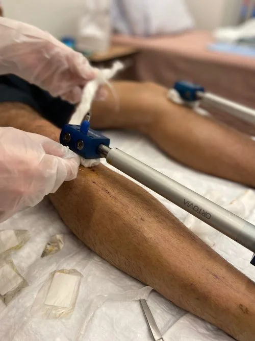 Pansuman Esnasında Hissedilen Ağrı - Boy Uzatma Ameliyatı