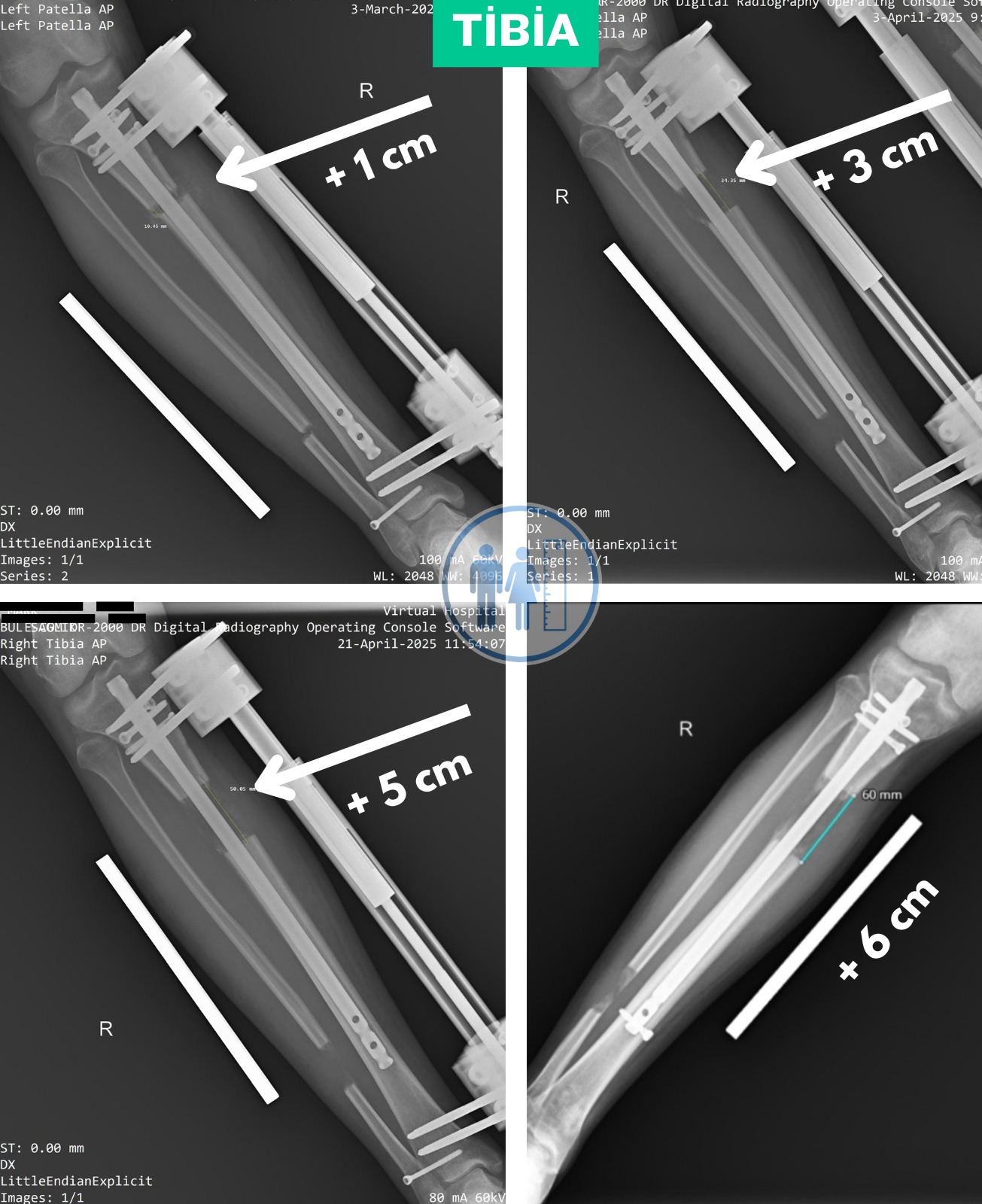 Tibia boy uzatmasından sonraki röntgenler.
