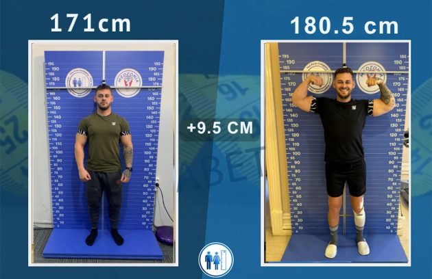 boy uzatma ameliyatı öncesi ve sonrası
