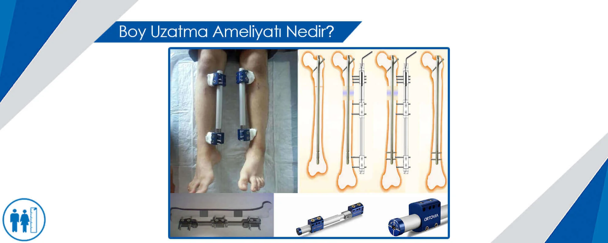 Boy Uzatma Ameliyatı Nedir