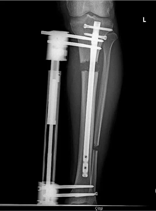 Boy Uzatma Ameliyatı Oldum Röntgen