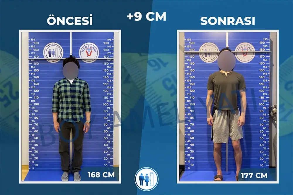 Boy Uzatma Ameliyatı Öncesi ve Sonrası