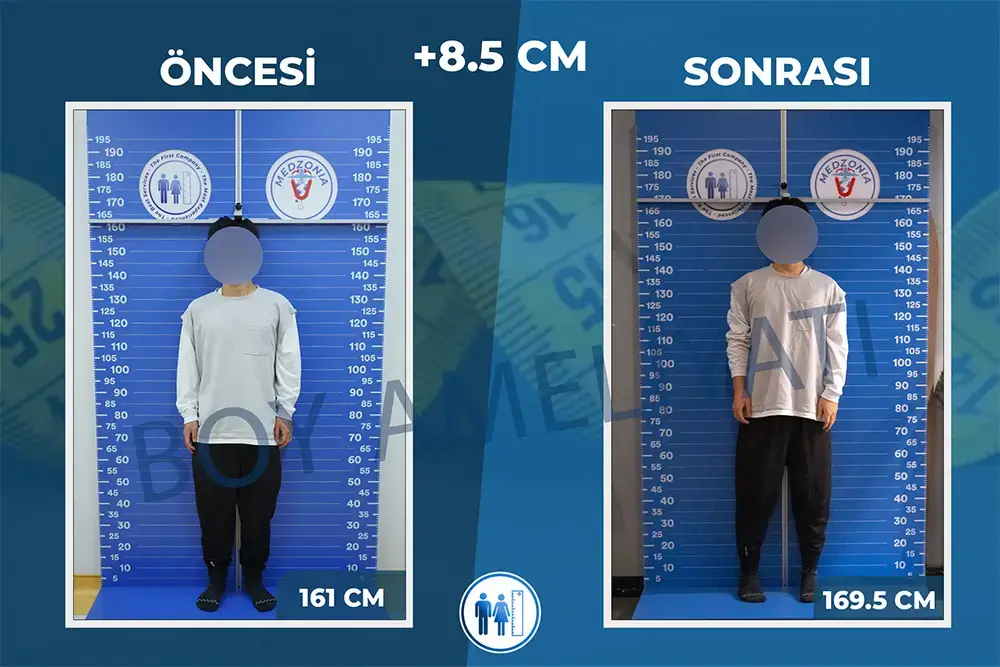 Boy Uzatma Ameliyatı Öncesi ve Sonrası