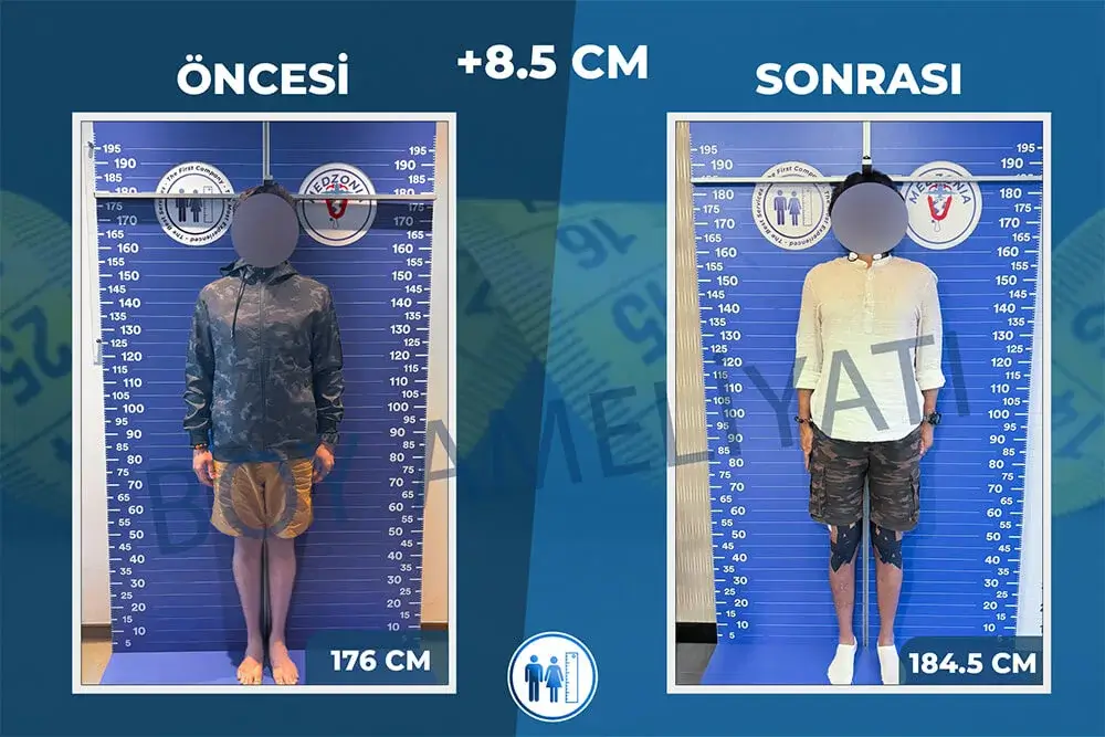 Boy Uzatma Ameliyatı Öncesi ve Sonrası