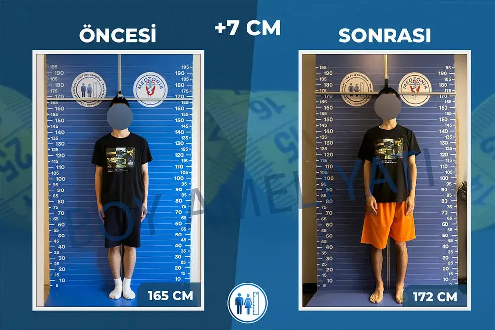 Boy Uzatma Ameliyatı Öncesi ve Sonrası