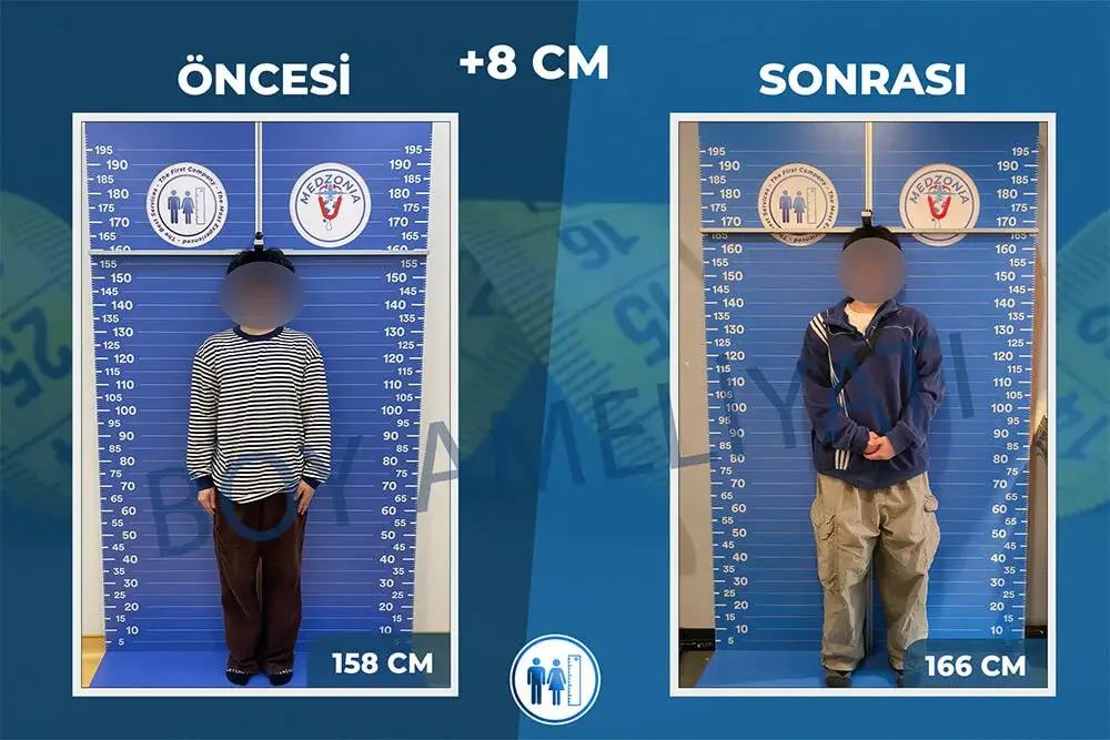 Boy Uzatma Ameliyatı Öncesi ve Sonrası