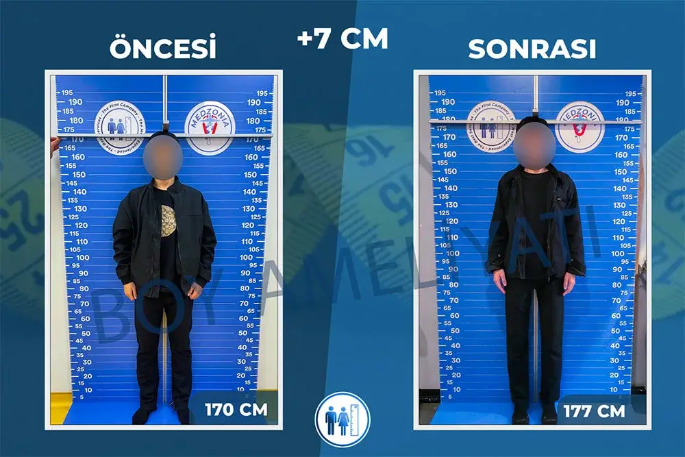Boy Uzatma Ameliyatı Öncesi ve Sonrası