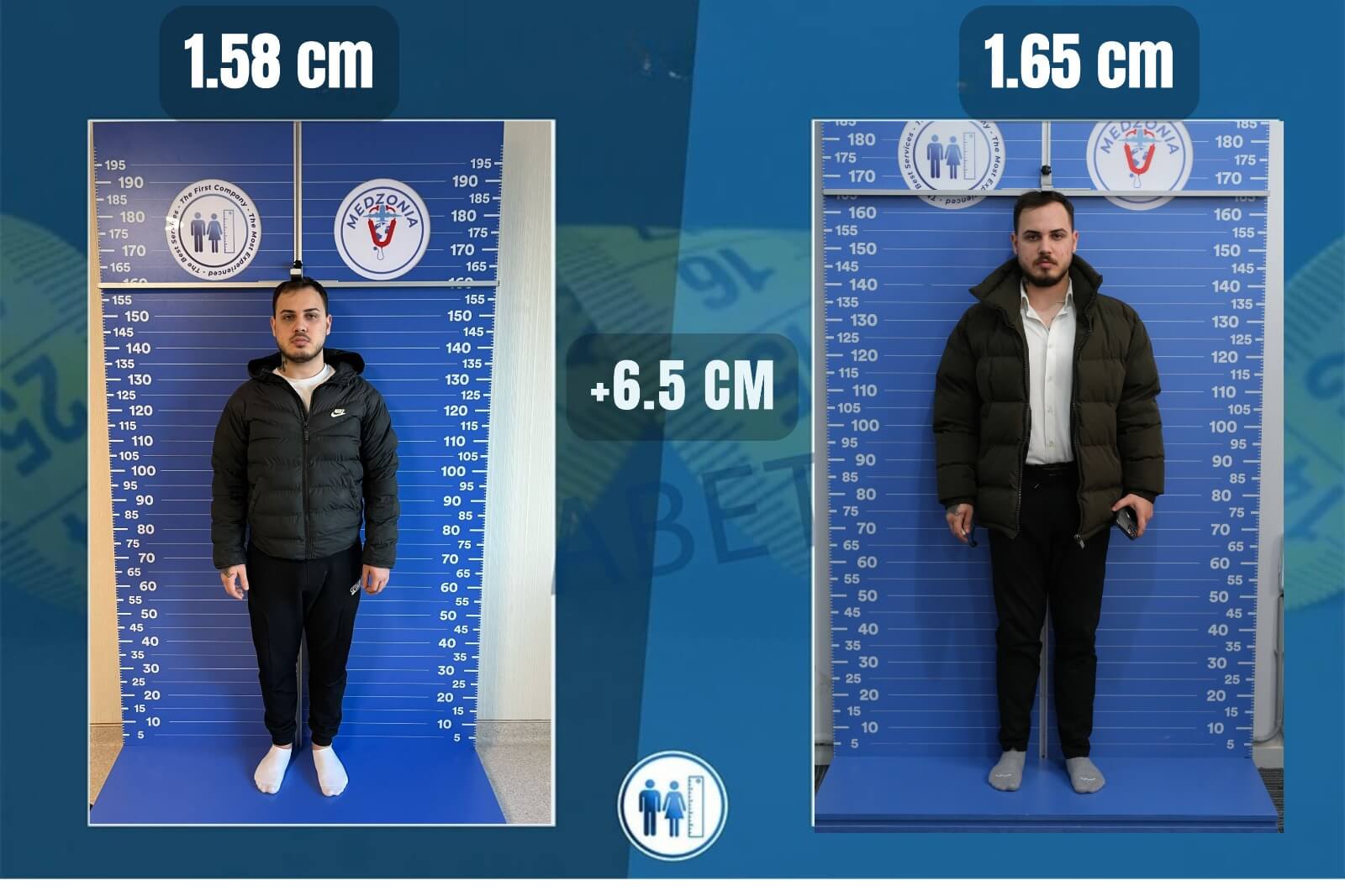 Boy Uzatma Ameliyatı Öncesi ve Sonrası