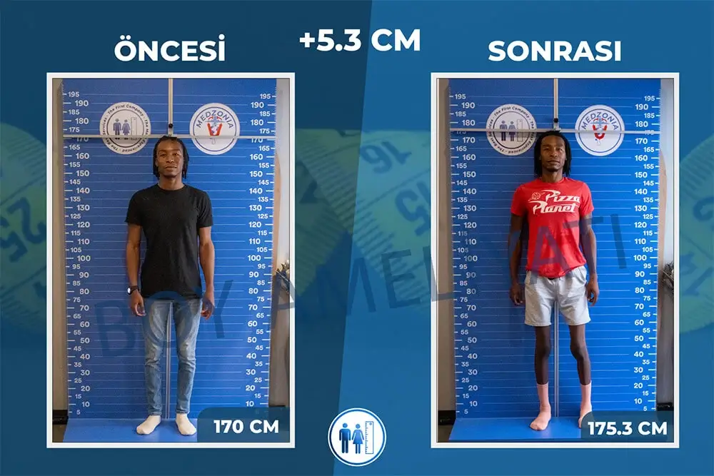 Boy Uzatma Ameliyatı Öncesi ve Sonrası