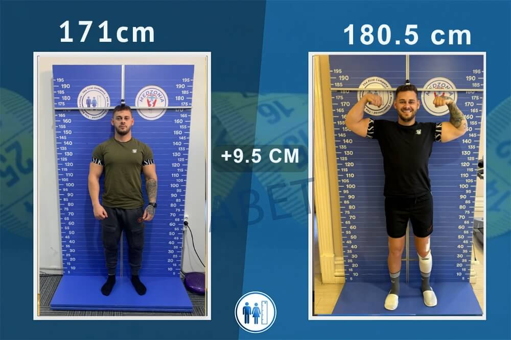 Boy Uzatma Ameliyatı Öncesi ve Sonrası