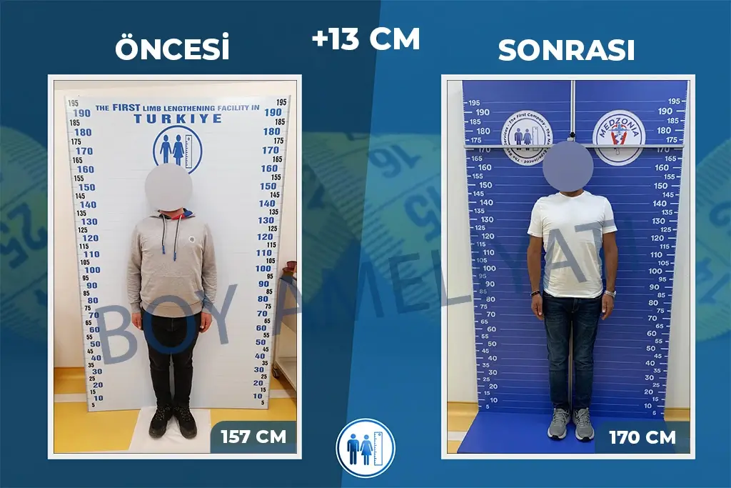 Boy Uzatma Ameliyatı Öncesi ve Sonrası