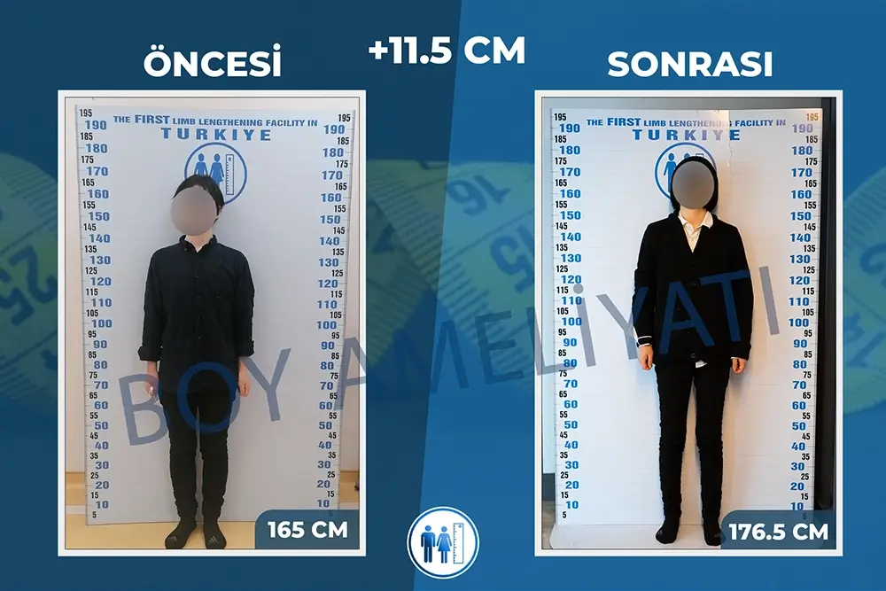 Boy Uzatma Ameliyatı Öncesi ve Sonrası