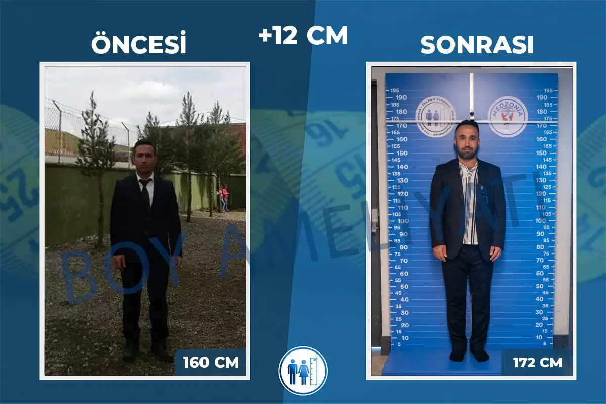 Boy Uzatma Ameliyatı Öncesi ve Sonrası
