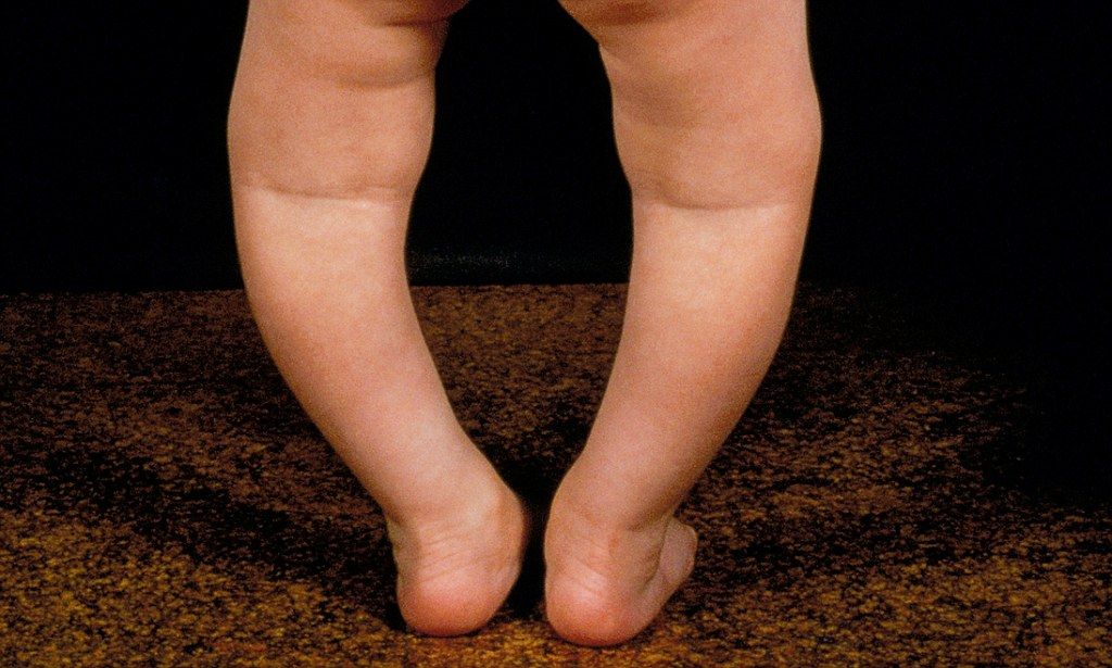 boyuzatmaameliyatı-raşitizm-genu-varum-o-bacak-deformite