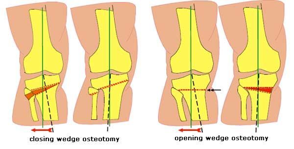 boyuzatmaameliyatı-yüksek-tibial-osteotomi-yöntem-deformite-düzeltme-eğrilik